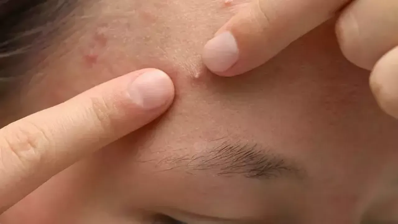 Akne nerede görülür, Ne anlama gelir? İşte cilt probleminizin sırrı