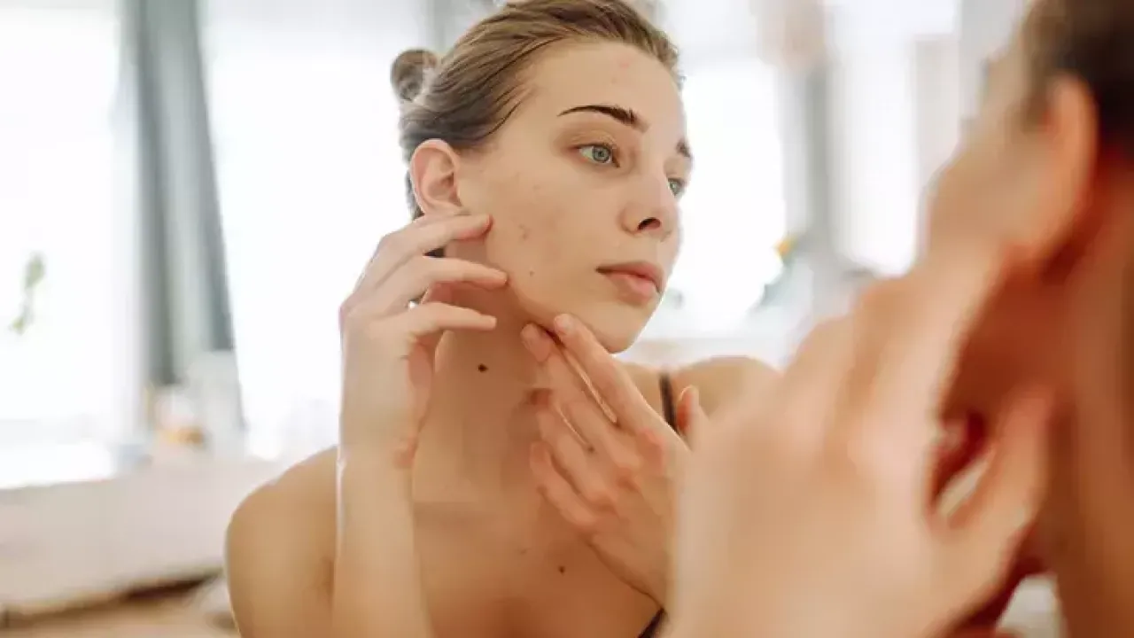 Akne nerede görülür, Ne anlama gelir? İşte cilt probleminizin sırrı