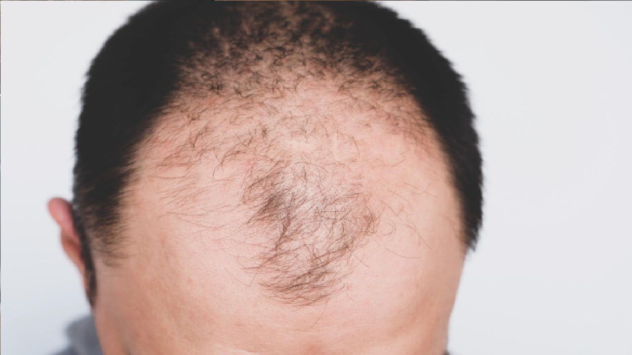 Saç ekimi devri kapanıyor mu? Kelliğe karşı yeni protein tedavisi umut oldu!