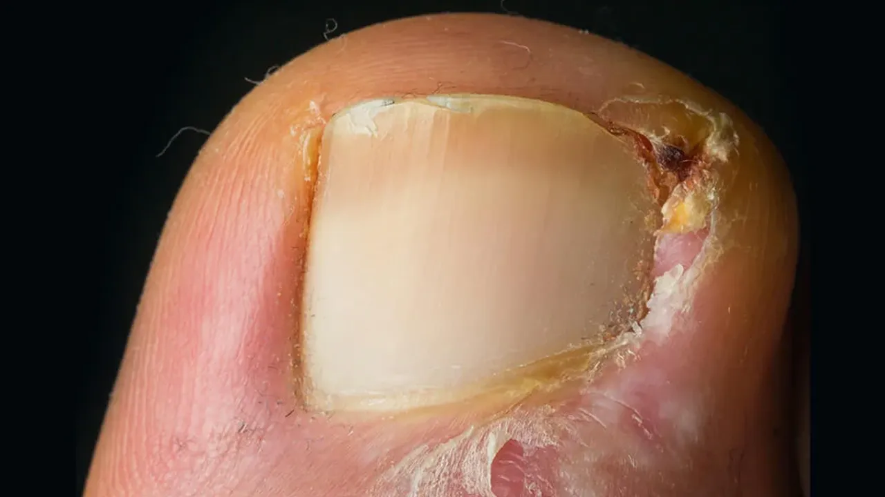 Tırnak batması kabusu 1 saatte bitiyor