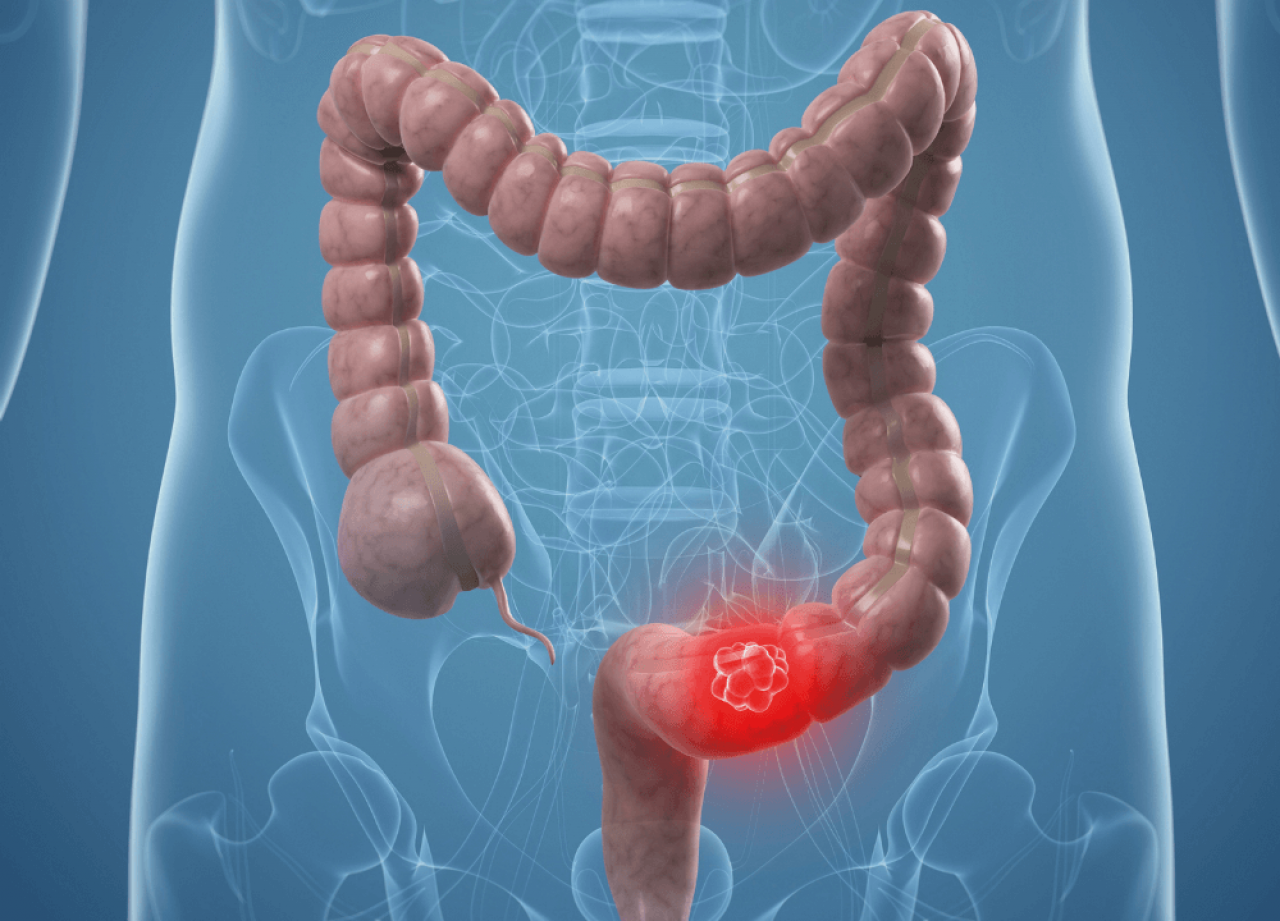 Genç yaşta kolon kanseri tehlikesi : Alarm zilleri çalıyor!