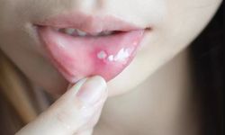 Aft nedir? Ağız içinde görülen bu yaralar neden oluşur, nasıl geçer?