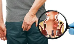 Hemoroitte devrim! Sadece 10 dakikada ağrısız tedavi mümkün mü?