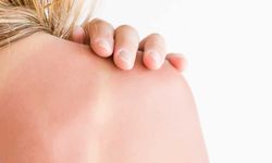 Aloe vera mı yoğurt mu? Güneş yanığına ne iyi gelir?