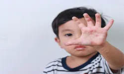 Şap hastalığı yayılıyor, paniklemeyin ama...