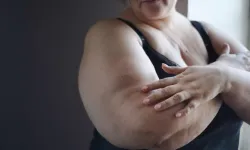 Obeziteyle savaşı kazandı: 1 yılda şaşırtan değişim!