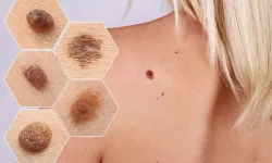 Dünyada en yaygın görülen kanserlerde ilk sırada!