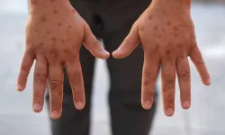 Mpox virüsü Gana’yı vurmaya devam ediyor: Vaka sayısı 302!