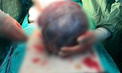 Cerrahlar bile şaşkına döndü: Karnından dev tümör çıktı