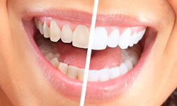 Sararan dişlere son: Doğal yolla bembeyaz dişler için uzmanlar 3 meyveyi öneriyor