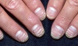 Tırnaklardaki beyaz lekeler neyin belirtisi? Uzmanlar açıkladı