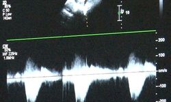 Doğumsal kalp hastalıkları gözden kaçıyor: Bu test hayat kurtarabilir