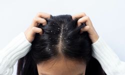 Kimyasal kullanmadan kepekten kurtulun