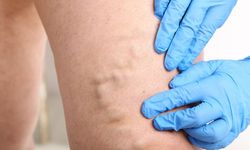 Varise karşı 8 etkili önlem ve tedavi için en uygun mevsim açıklandı!