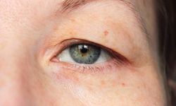 Ameliyat korkusu olanlara umut: Göz kapağında yeni yöntem