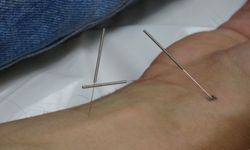 İlaçlar çare olmadı, bu yöntemle ağrılarından kurtuldular