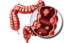 Kolorektal kanser: Erken tanı ve cerrahi hayati öneme sahip