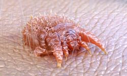 Türk Dermatoloji Derneği’nden uyuz uyarısı