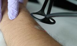 Bu ayrıntıyı bilmeden lazer yaptıran yandı