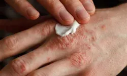 Duştan sonra yapılan bu hata egzama şikayetlerini artırıyor