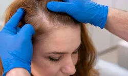 Kadınlarda saç dökülmesinin şaşırtan sebepleri