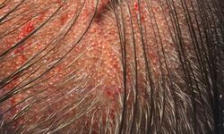 Tıraşsız saç ekimi artık mümkün