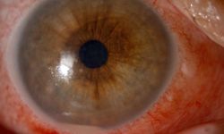 Göz sağlığında tehlikeli trend: Kırlangıç otu uyarısı