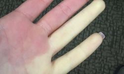 El ve ayaklardaki renk değişimine dikkat: Raynaud belirtisi olabilir!