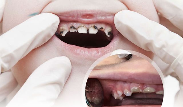 Bu basit hata çocuğunuzun dişlerini mahvedebilir!