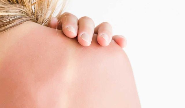Aloe vera mı yoğurt mu? Güneş yanığına ne iyi gelir?
