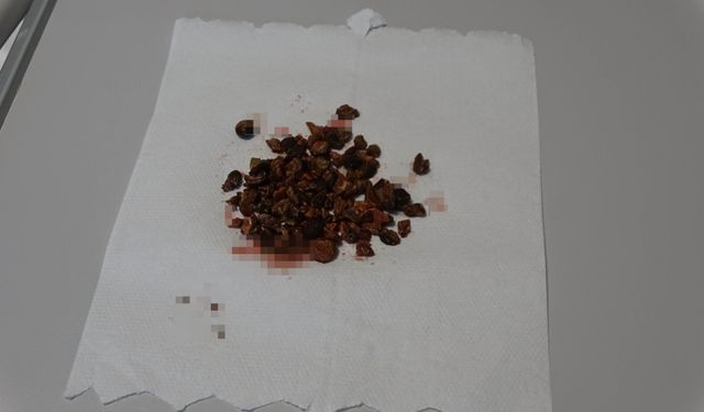 Doktorlar şaşkına döndü: Yozgat’ta bir böbrekten tam 100 taş çıktı!
