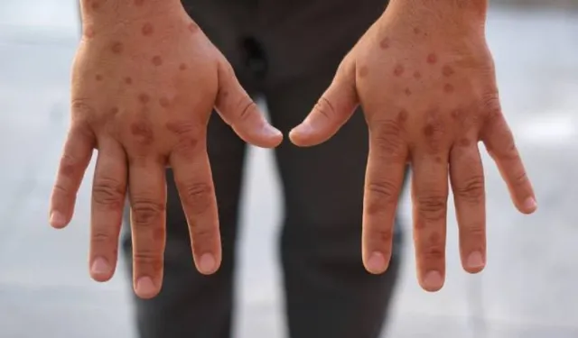 Mpox virüsü Gana’yı vurmaya devam ediyor: Vaka sayısı 302!
