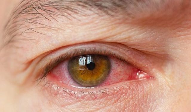 Soğuk ve kuru hava gözleri vuruyor: Kuruluğa karşı önlem alın