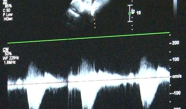 Doğumsal kalp hastalıkları gözden kaçıyor: Bu test hayat kurtarabilir