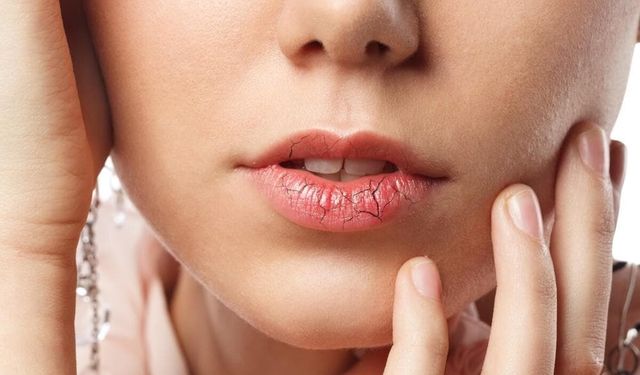 Dudak kuruluğuna 1 gecede çözüm mümkün mü? İşte cevabı!