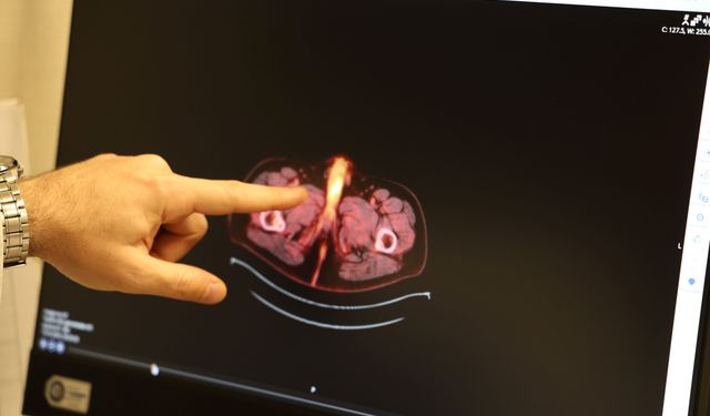 Dünyada 60 kişide görüldü, son vaka Diyarbakır’dan