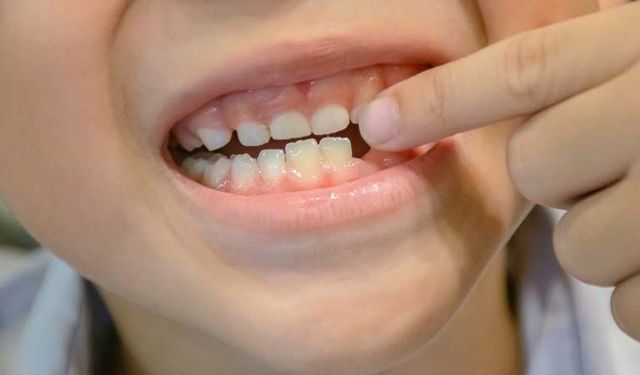 Rüyada diş dökülmesi ne anlama gelir?