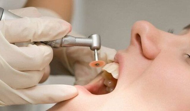 Diş taşlarını evde temizlemenin doğal yolları: Tartar oluşumu nasıl engellenir?