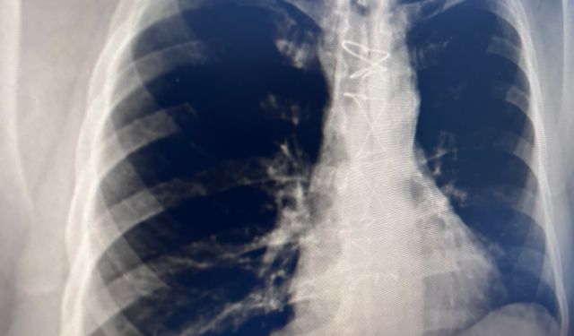 ‘Daha az zararlı’ denmişti, akciğeri bitiriyor