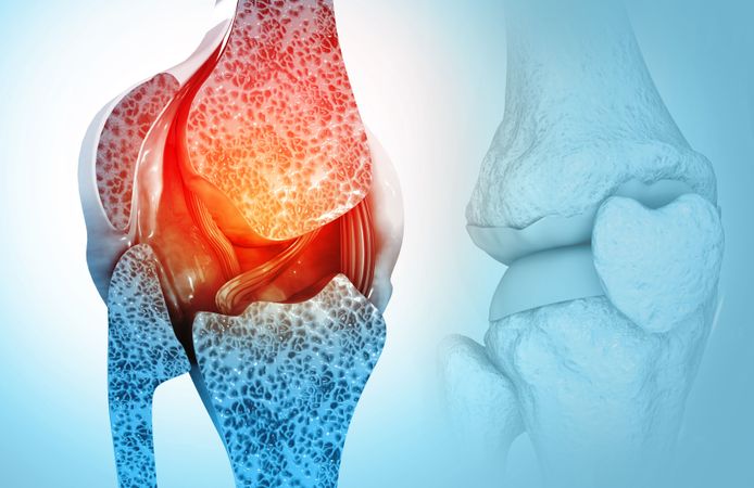 Kemik erimesi erken dönemde tespit edilebilir!