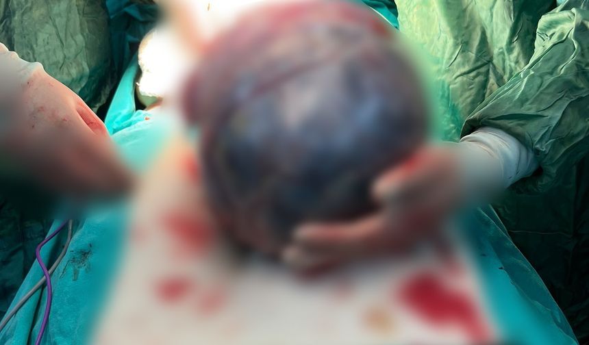 Cerrahlar bile şaşkına döndü: Karnından dev tümör çıktı
