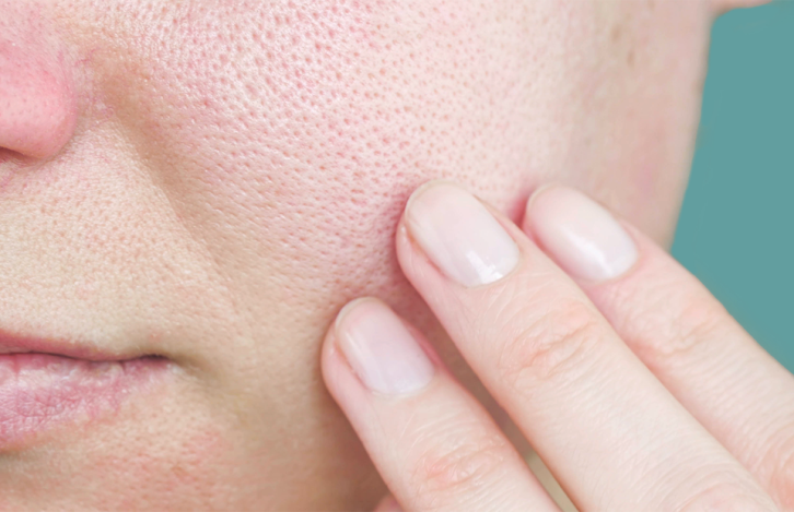 Clogged Pores