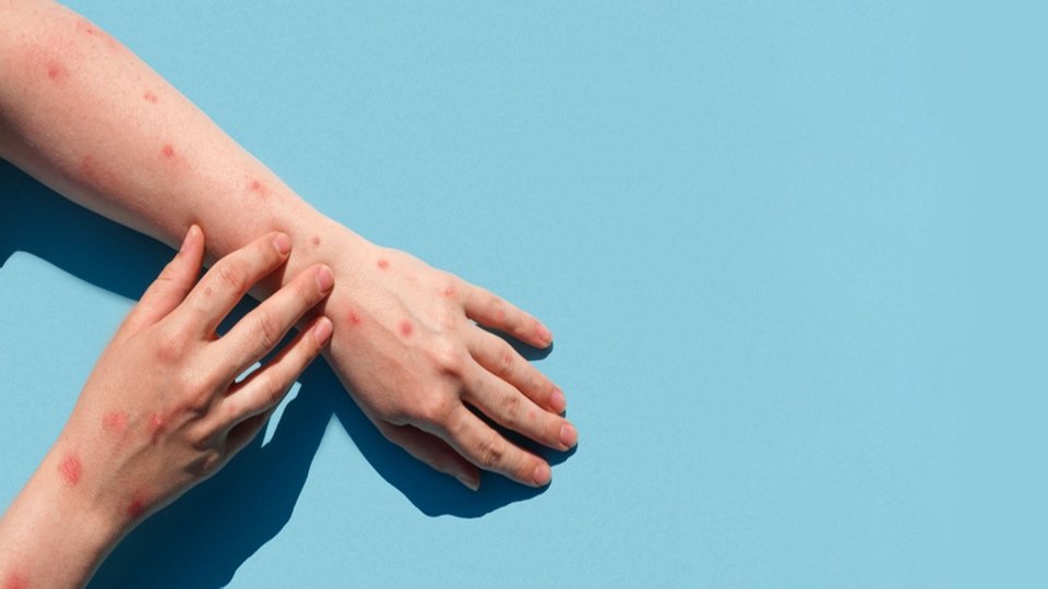 Maymun Cicegi Virusunun Belirtileri Buyuk Anadolu Hastanesi