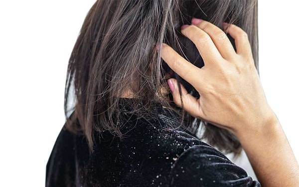 Kimyasal Kullanmadan Kepekten Kurtulun