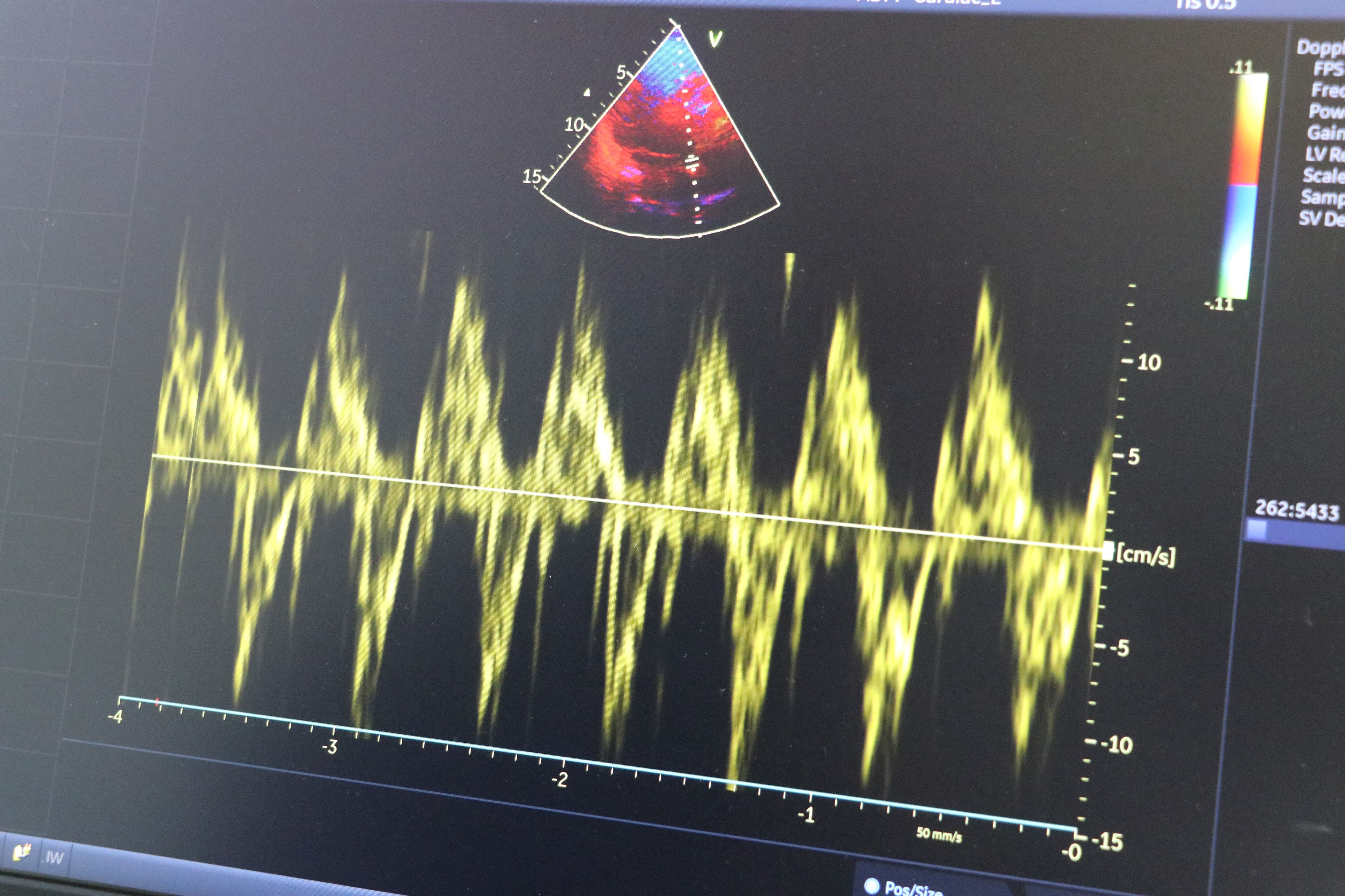 Kış Aylarında Kalp Hastalarına Önemli Uyarılar (1)