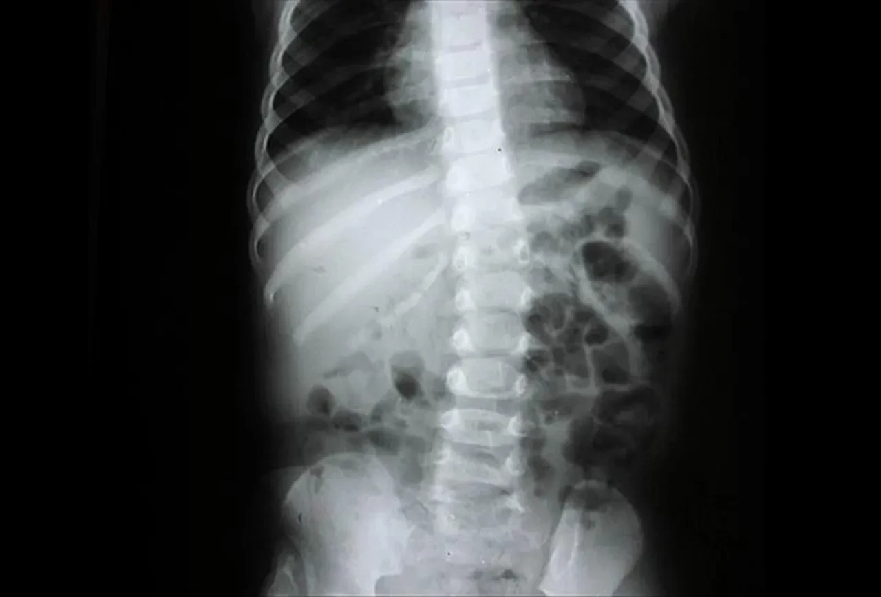 Arka Cepte Cüzdan Taşıyanlar Dikkat! Omurganızı Sessizce Çökertiyor (1)