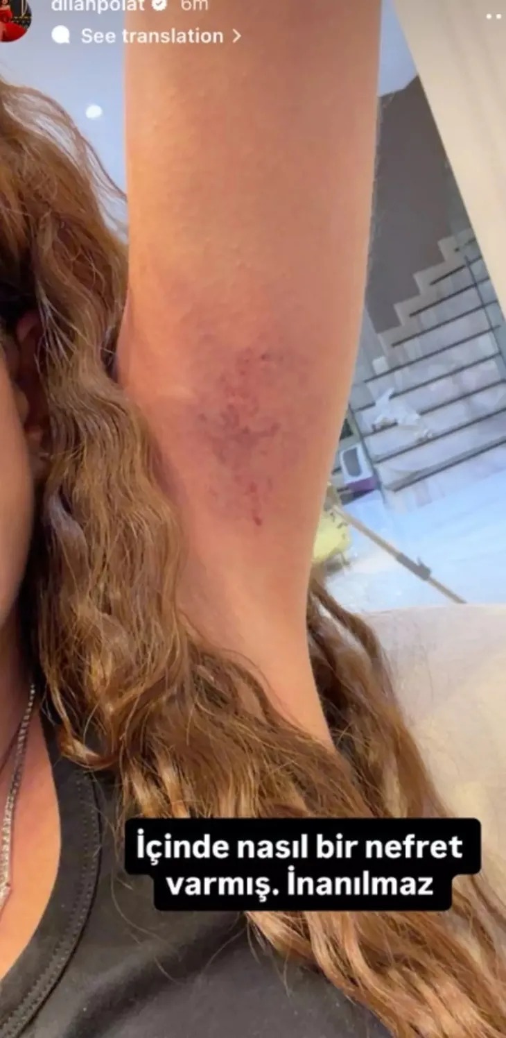 Dilan Polat'ı Tekme Tokat Dövdü! Darp Görüntülerini Paylaştı (1)