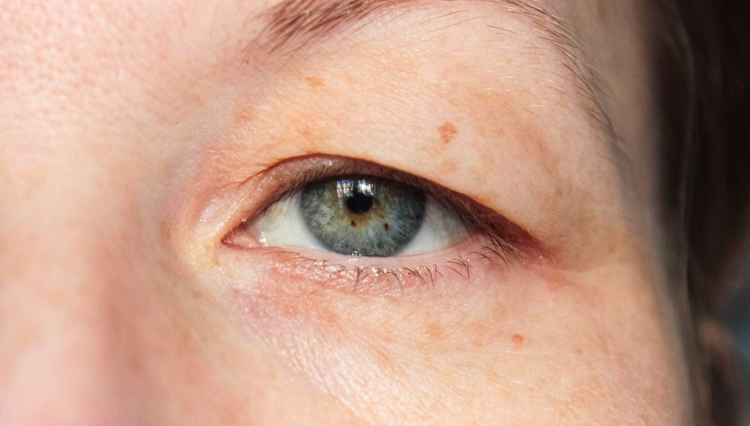 Göz Çevresindeki Yaşlanma Belirtilerine Ameliyatsız Çözüm Arayışı Sürerken, Plexr Lazer Uygulaması Dikkat Çekiyor. (2)