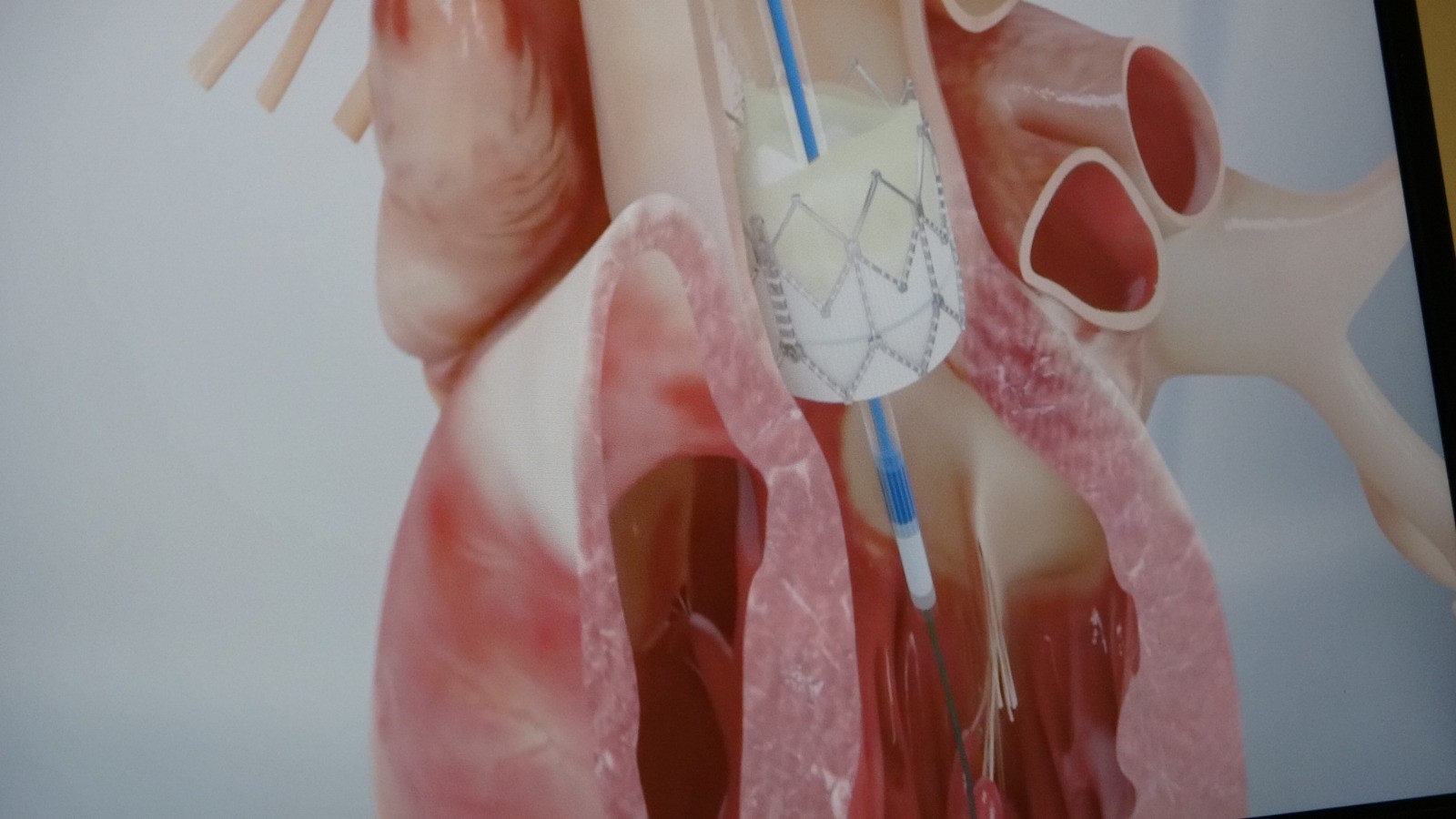 Genç Yaşta Ani Ölümün Şaşırtan Nedeni (1)