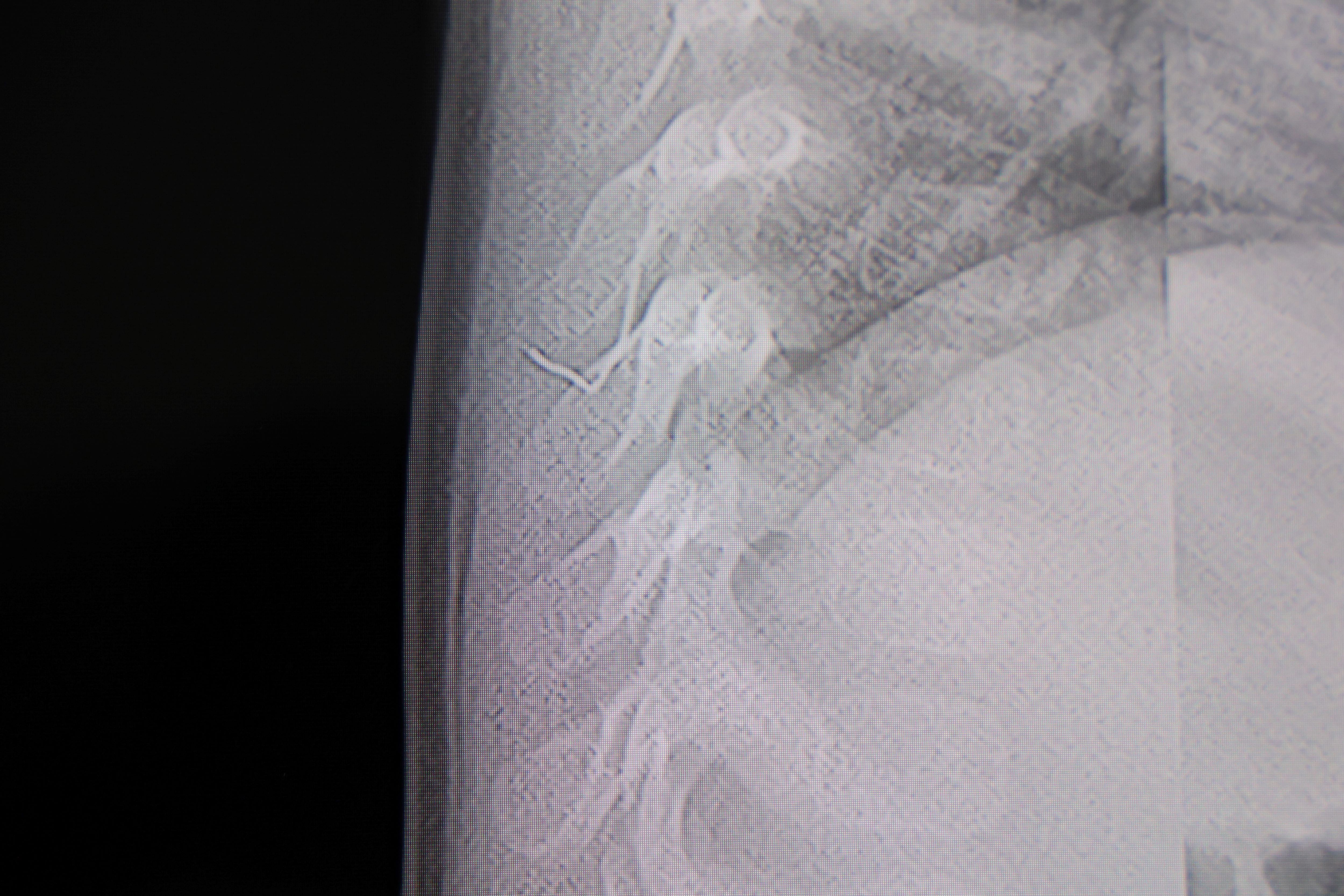 Kan Donduran Olay! Bebeğin Sırtından Tel Parçası Çıktı (4)